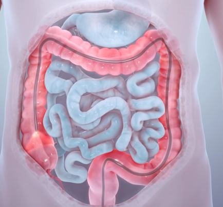 What is the Best Treatment for Colorectal Cancer? A Comprehensive Overview