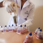 Discover the Benefits of Cupping Therapy in Bangkok: A Comprehensive Guide